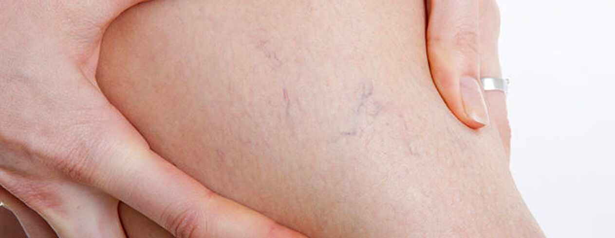 how varicose veins work