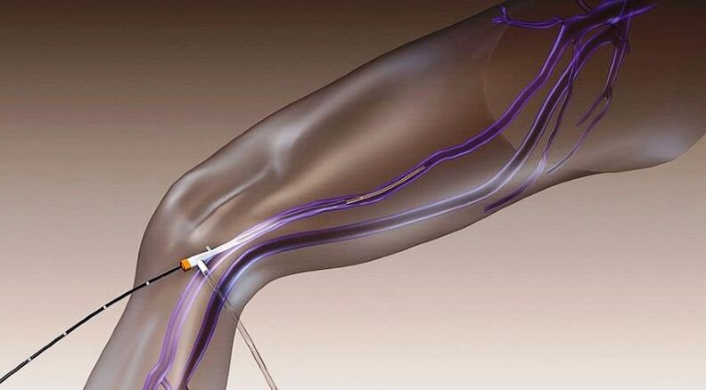 Radiofrequency obliteration a method to treat varicose veins